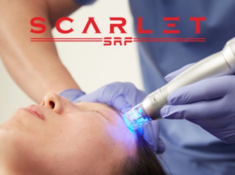 Scarlet RF Microneedling