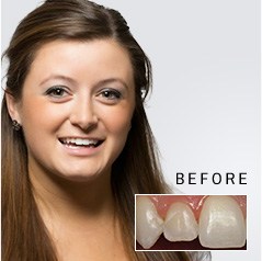 Young woman before and after treatment from dentist in Whitinsville