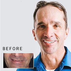 Man smiling before and after tooth replacement from Whitinsville dentist