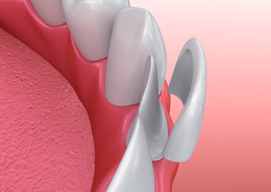 Veneer being placed onto a tooth