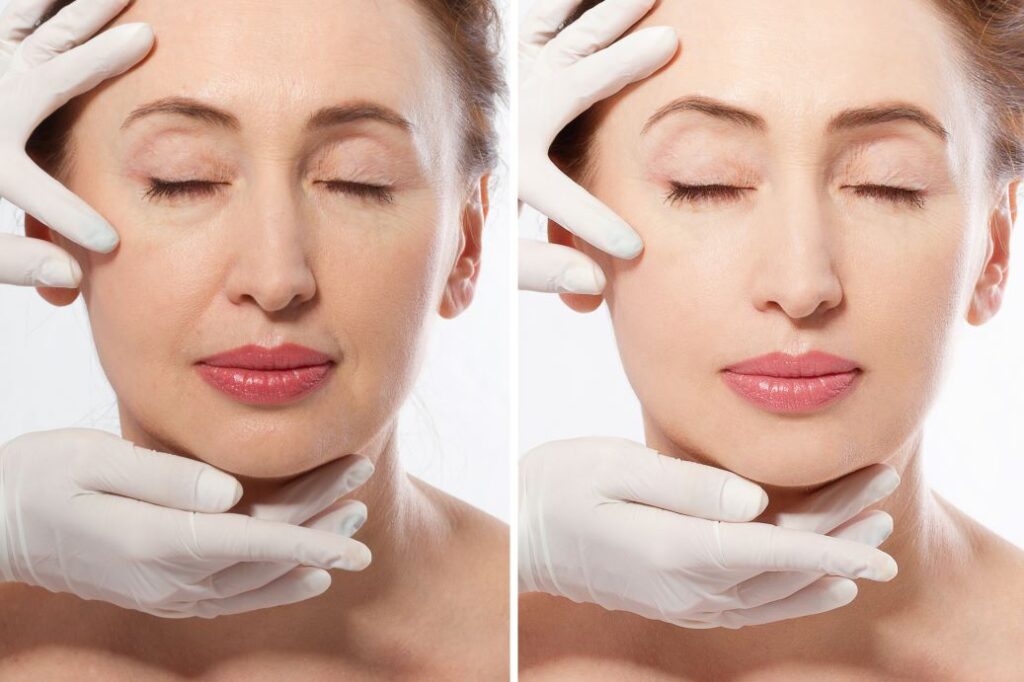 A woman before and after dermal fillers on her laugh lines.